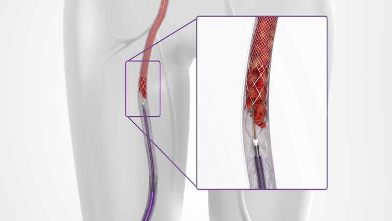 ClotTriever BOLD in Anatomy