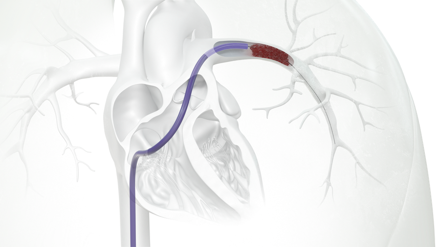 T20 Curve - LPA Clot